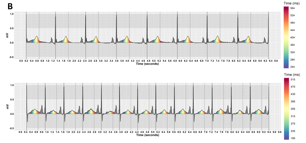 A prolonged QT interval at a slow (top) and fast (bottom) heart rate